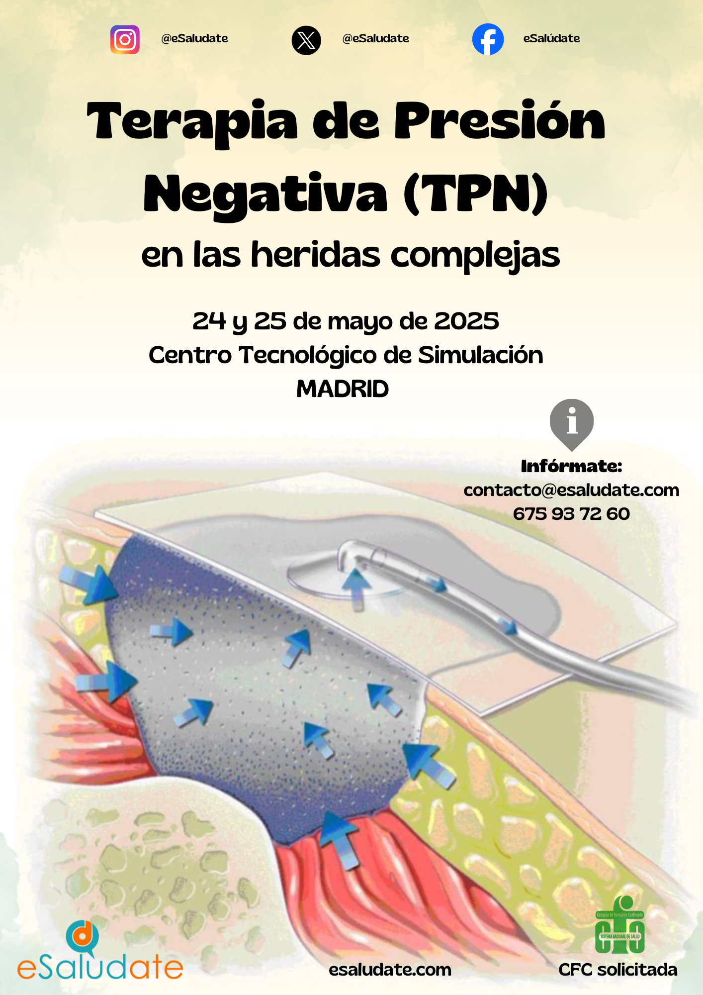 TPN Terapia Presin Negativa Heridas Complejas