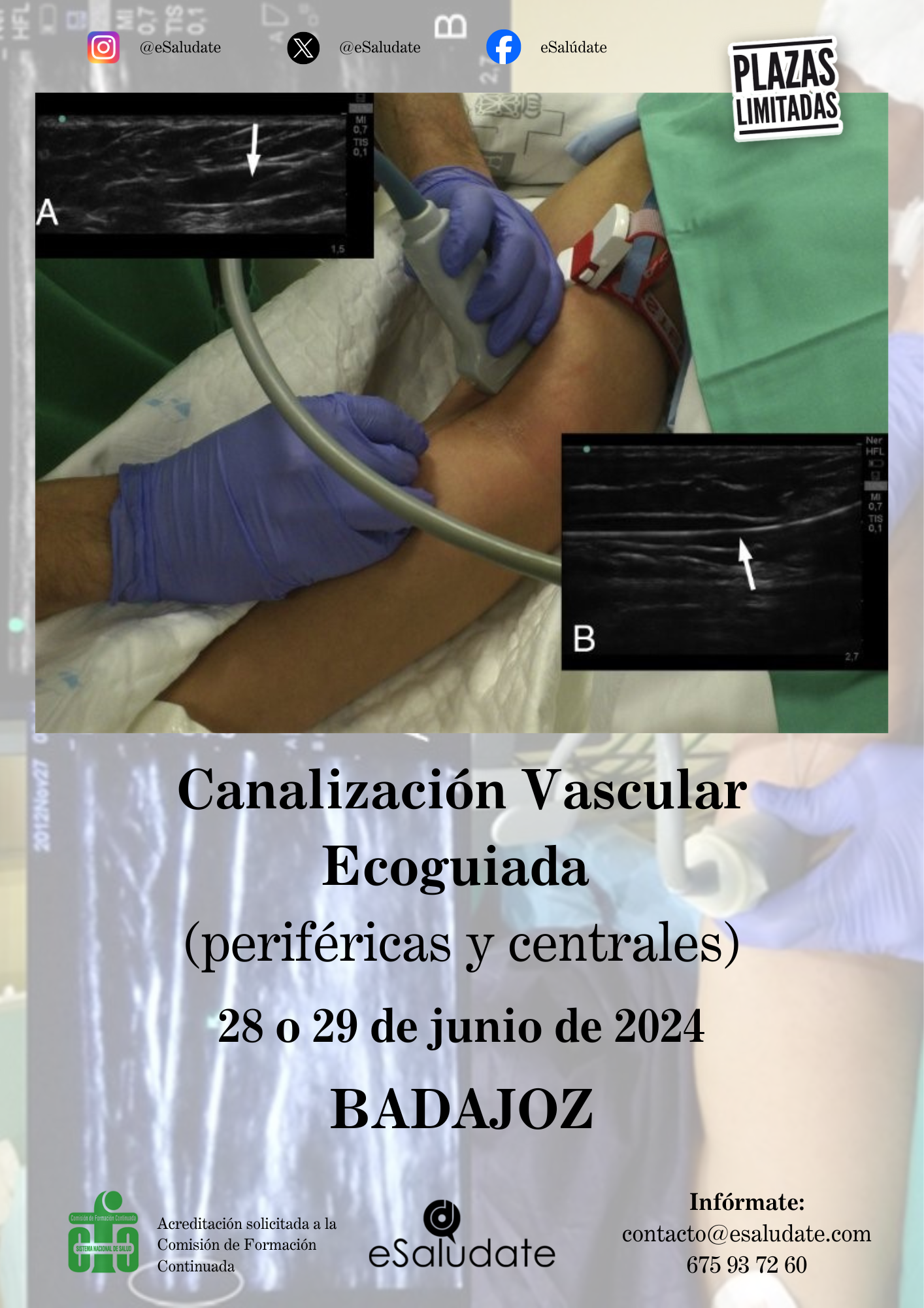 Canalizacin Vascular (1)