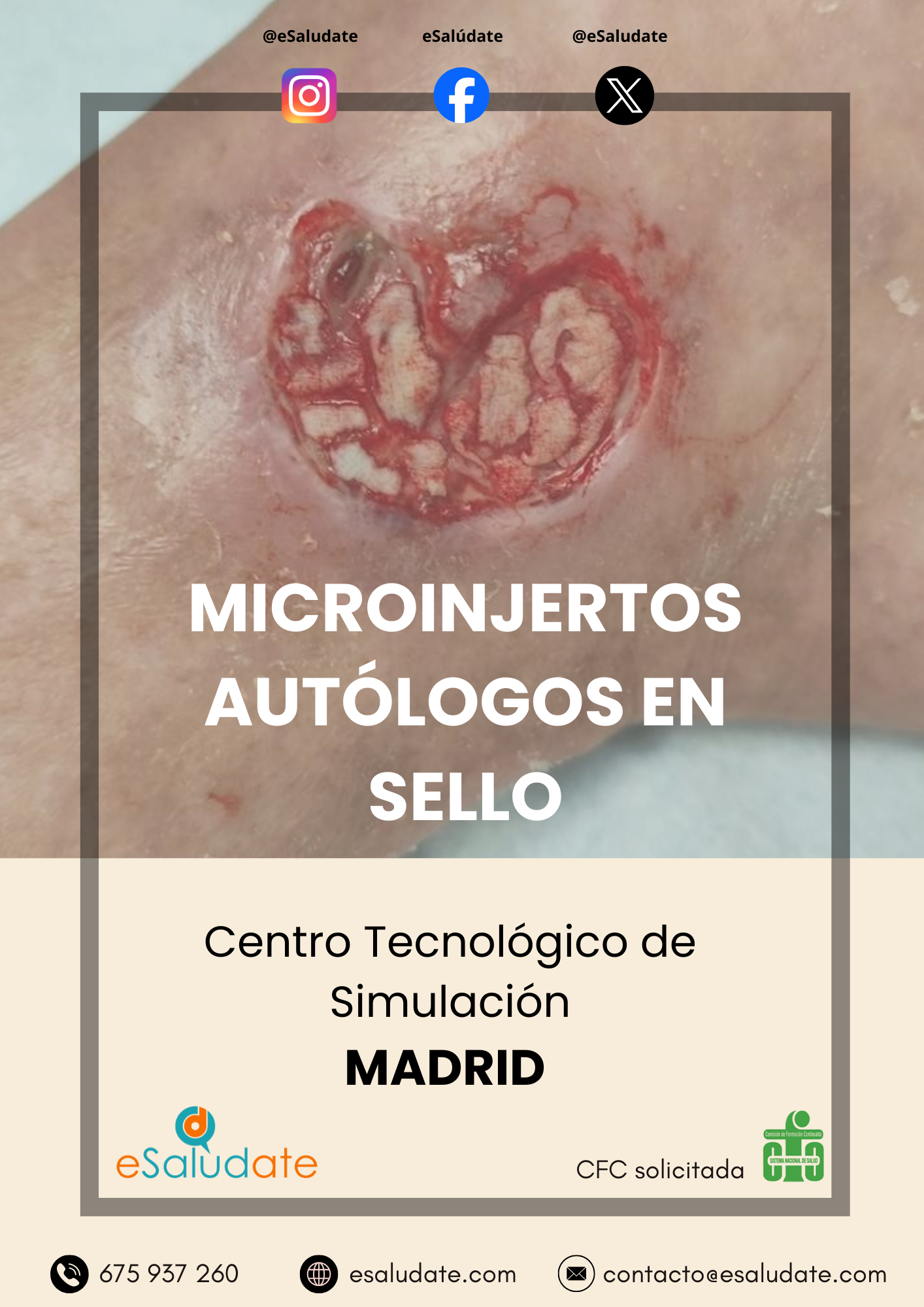 Microinjertos En Sello 